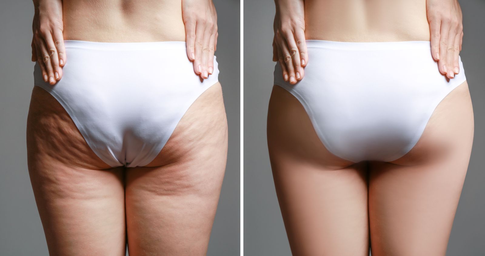 kältekammer gegen cellulite