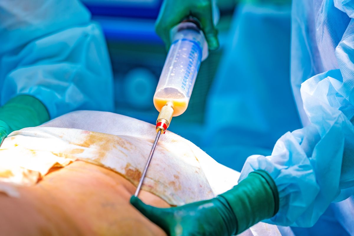 liposuktion bei lipödem