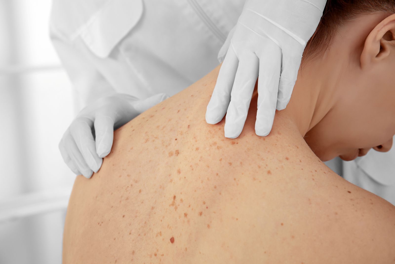 Kryotherapie Hautarzt